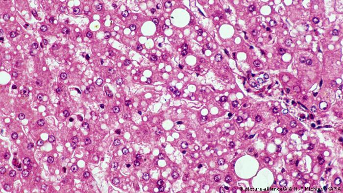 Mikroskopaufnahme Fettleber (picture-alliance/A.& H.-F.Michler/OKAPIA)